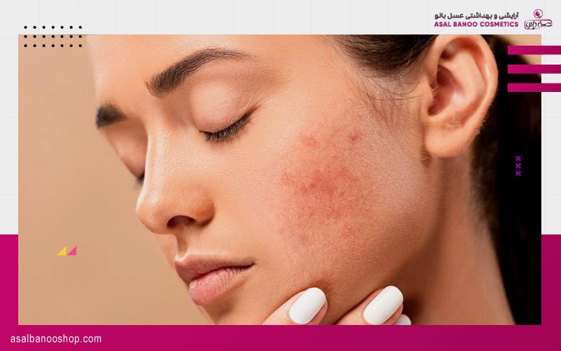Pimple-face-blog برای جلوگیری از جوش زدن صورت در اثر استفاده از ماسک چه کاری باید کرد؟