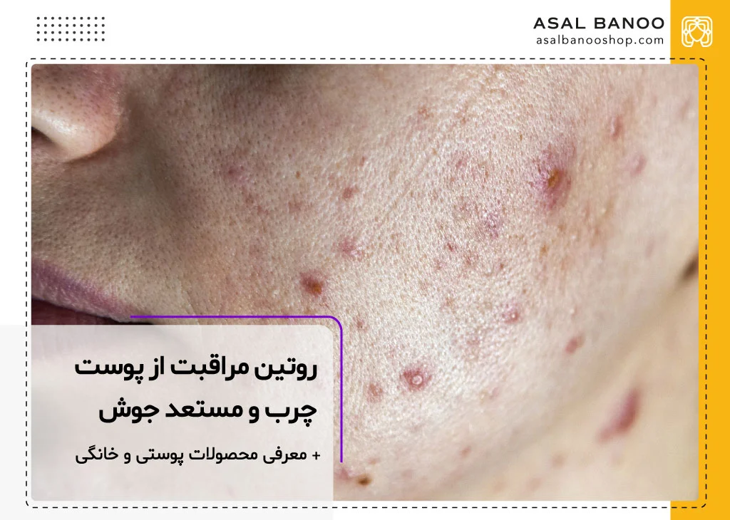 برنامه مراقبت از پوست چرب و جوش دار