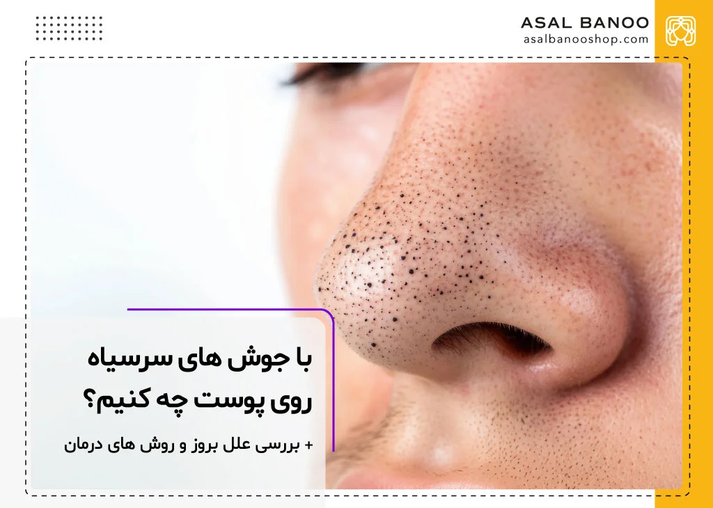 راه های درمان سریع جوش سر سیاه بینی