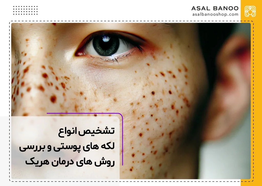 شناخت انواع لکه های پوستی و روش درمان هر کدام