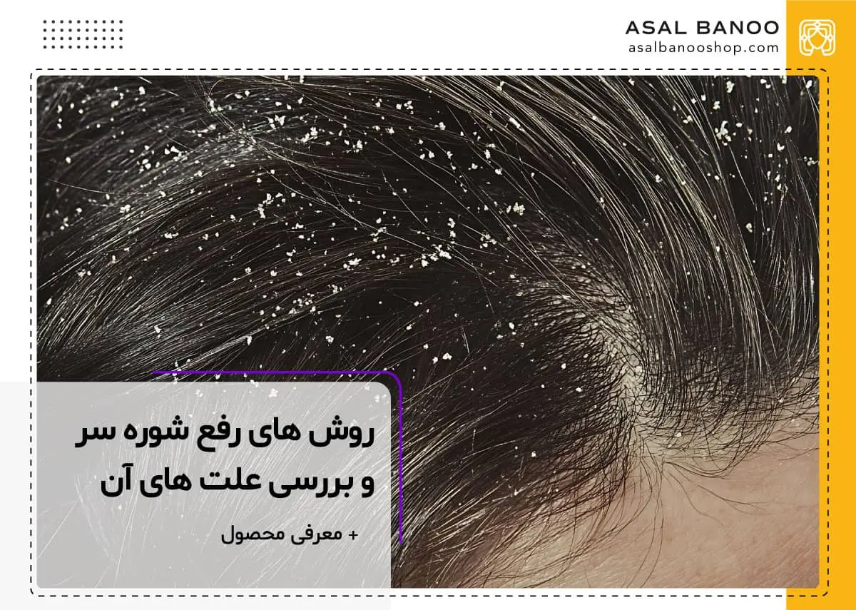 زاه های رفع شوره سر