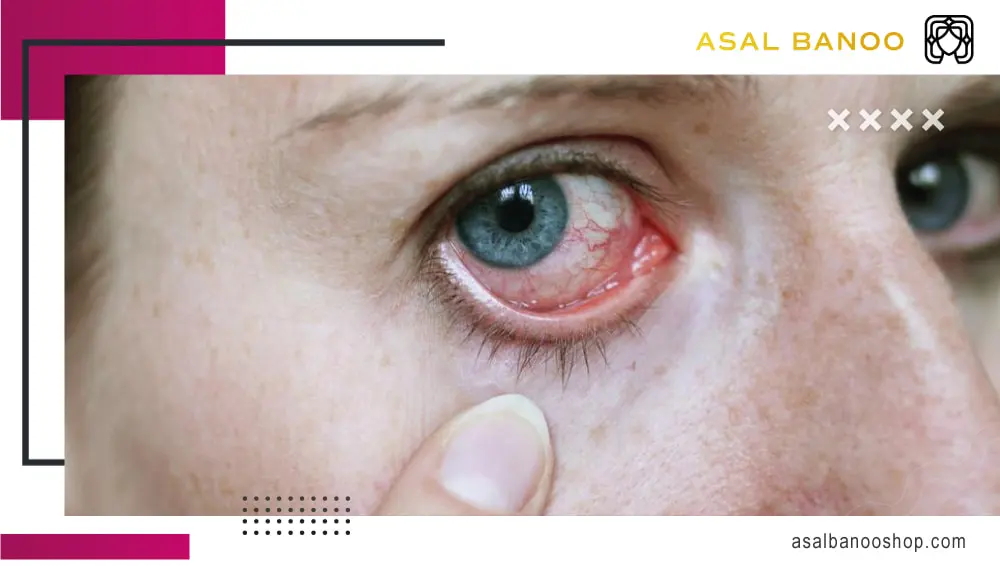 Eye-irritation-and-infection قرمزی چشم