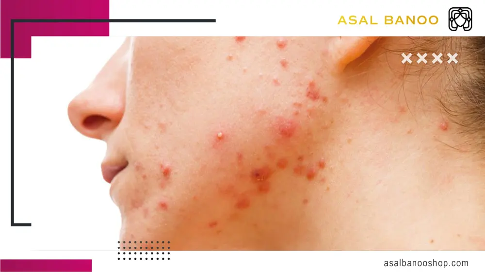 acne بروز جوش در اثر خوابیدن با آرایش