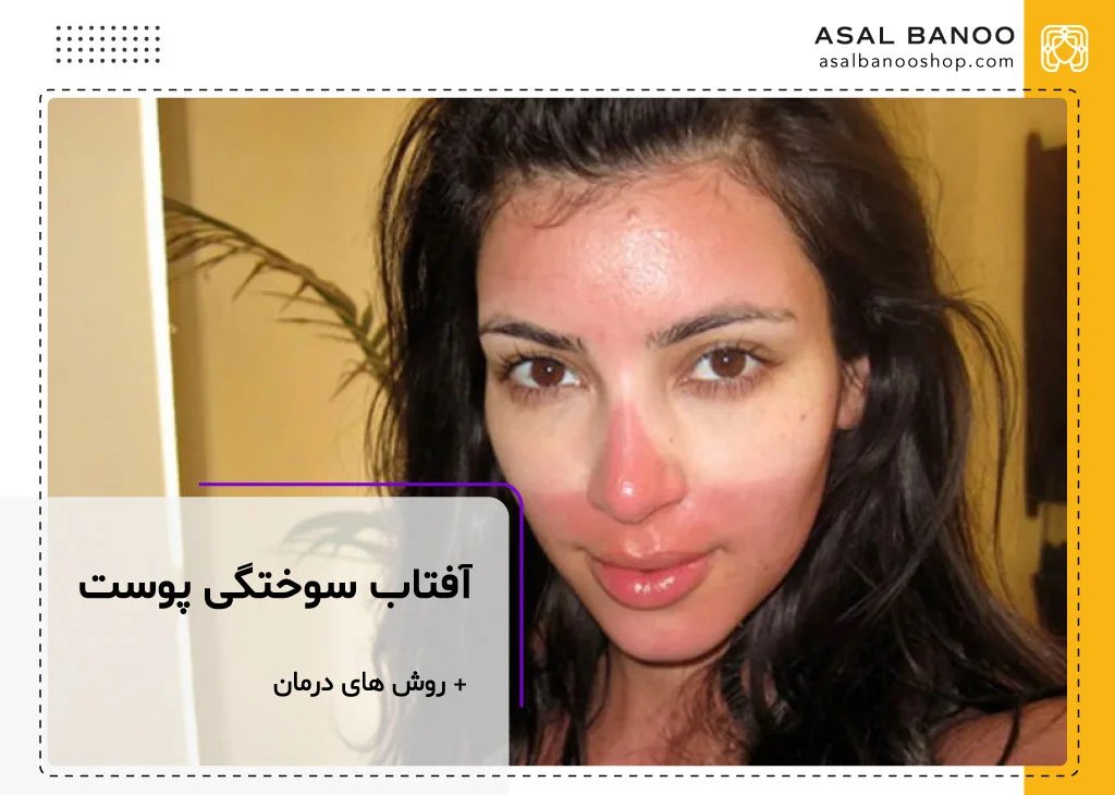آفتاب سوختگی پوست