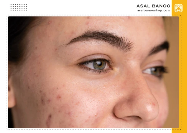 best-repair-cream-to-remove-pimples چگونه از ایجاد جای جوش جلوگیری کنیم؟