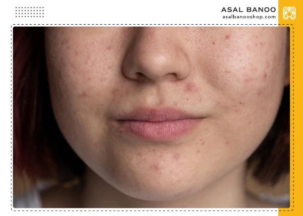 repair-cream-to-remove-pimples سایر روش ها درمان جای جوش، زخم و اسکار