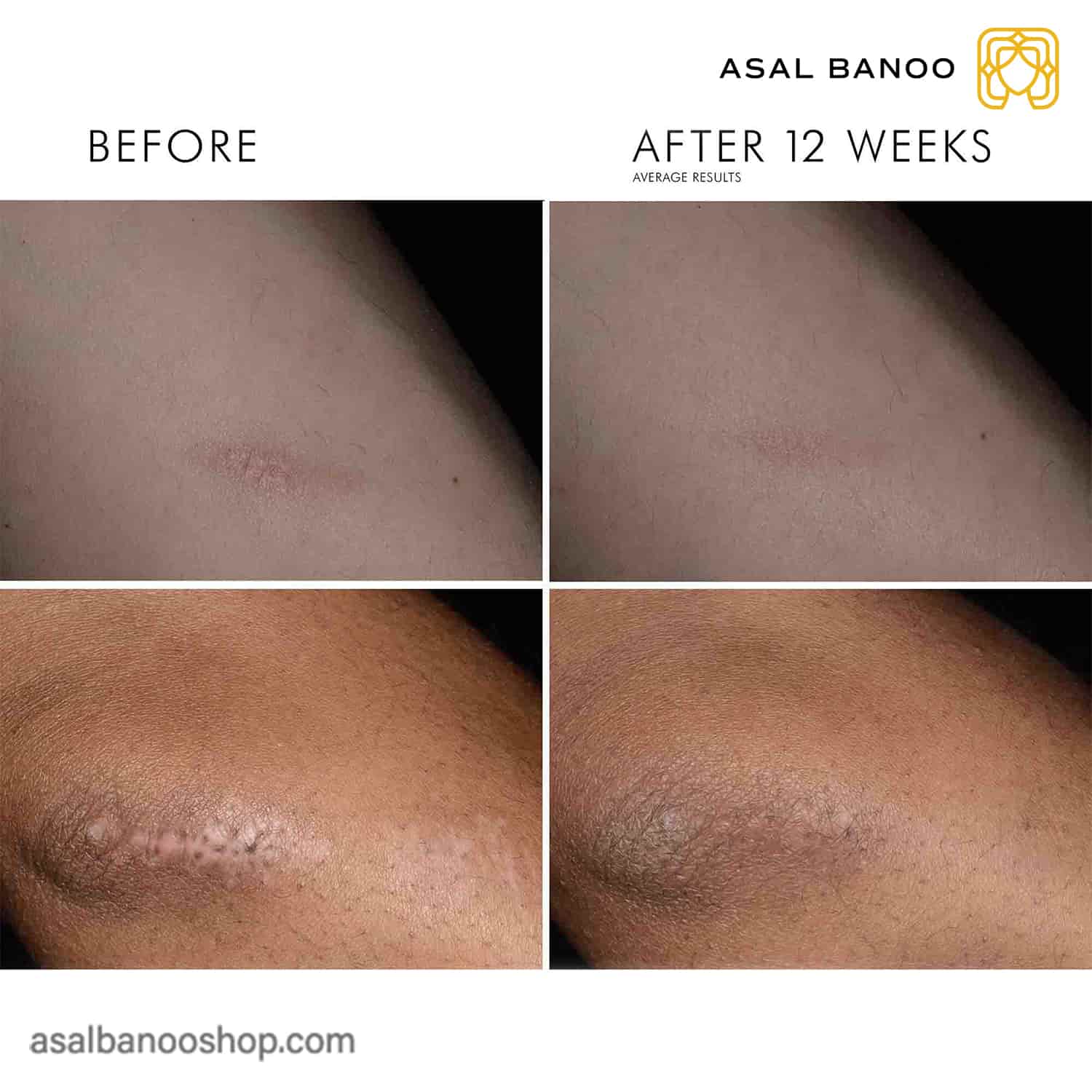 SkinCeutical-Advanced-Scar-Control-beforafter-min ژل رفع اسکار اسکین سوتیکال