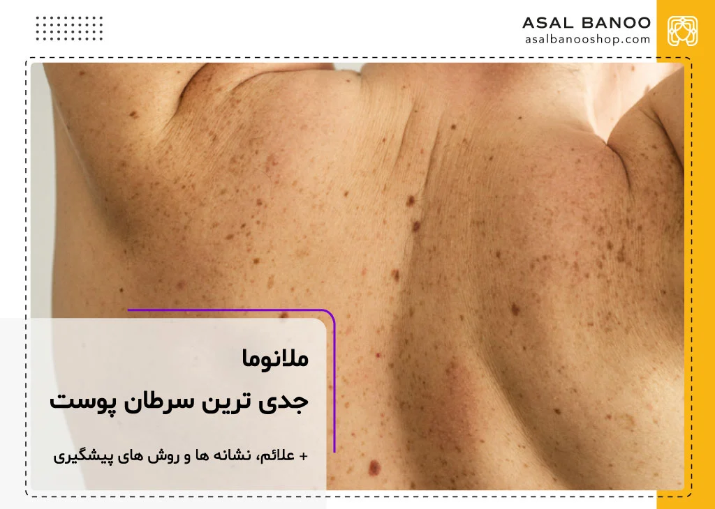 ملانوما چیست و چه علائمی دارد؟