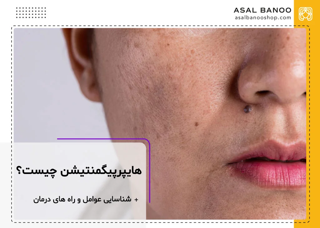 هایپرپیگمانتاسیون چیست؟
